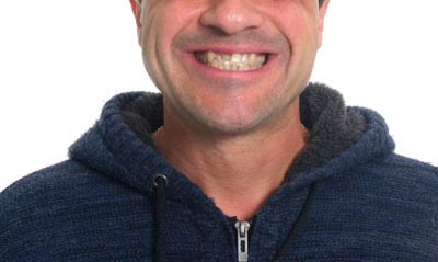 Tratamiento correctivo en adultos. Caso clínico: antes.