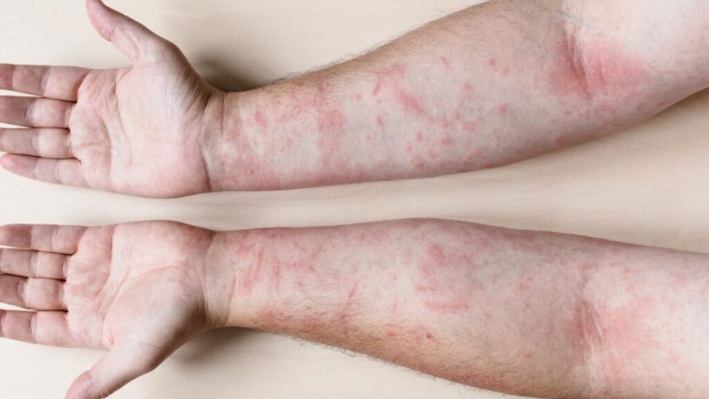 Día Mundial del Lupus: Visibilizando una enfermedad silenciosa y complicada | 5 | Día Mundial del Lupus: Visibilizando una enfermedad silenciosa y complicada - Noticias de hoy en República Dominicana | De Último Minuto