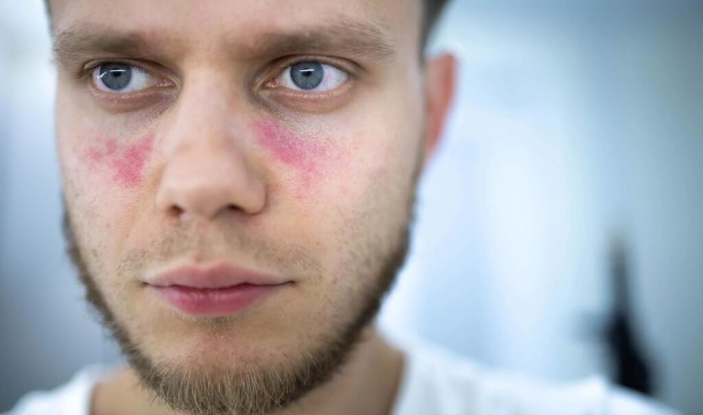 Día Mundial del Lupus: Visibilizando una enfermedad silenciosa y complicada | 3 | Día Mundial del Lupus: Visibilizando una enfermedad silenciosa y complicada - Noticias de hoy en República Dominicana | De Último Minuto