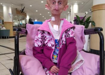 Muere la tiktoker de 19 años que luchaba contra una rara enfermedad genética