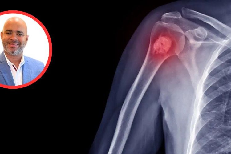 Aumentan tumores a nivel óseo en pacientes luego del Covid-19, afirman especialistas