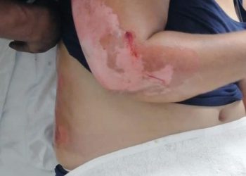 Muere mujer que resultó quemada junto a su esposo al rescatar a sus hijos durante incendio en Santiago