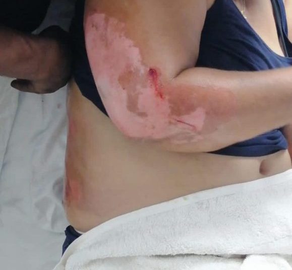 Muere mujer que resultó quemada junto a su esposo al rescatar a sus hijos durante incendio en Santiago