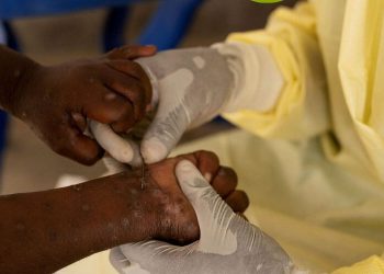 OMS levanta la emergencia sanitaria internacional por mpox tras disminución de casos