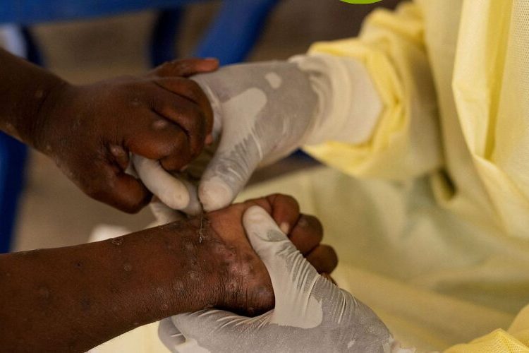 OMS levanta la emergencia sanitaria internacional por mpox tras disminución de casos