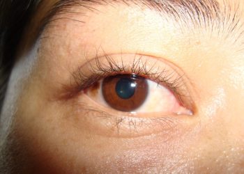 Las enfermedades de la retina: un llamado a la prevención para proteger la visión