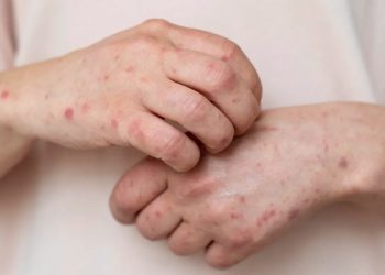 Suman 44 casos de sarampión en Paraguay y detectan el primero fuera del foco del brote