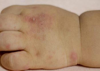 Mano-boca-pie: la enfermedad infantil que requiere atención inmediata en niños menores de cinco años