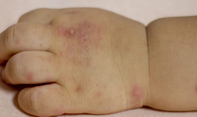 Mano-boca-pie: la enfermedad infantil que requiere atención inmediata en niños menores de cinco años