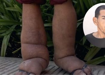 Hombre afectado por elefantiasis en Brisa del Este clama por ayuda