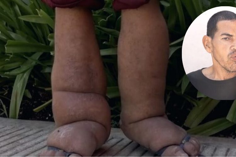 Hombre afectado por elefantiasis en Brisa del Este clama por ayuda