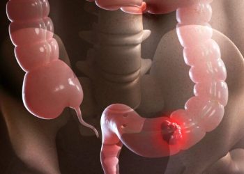 El cáncer colorrectal se protege de la inmunoterapia con un doble escudo, según un estudio