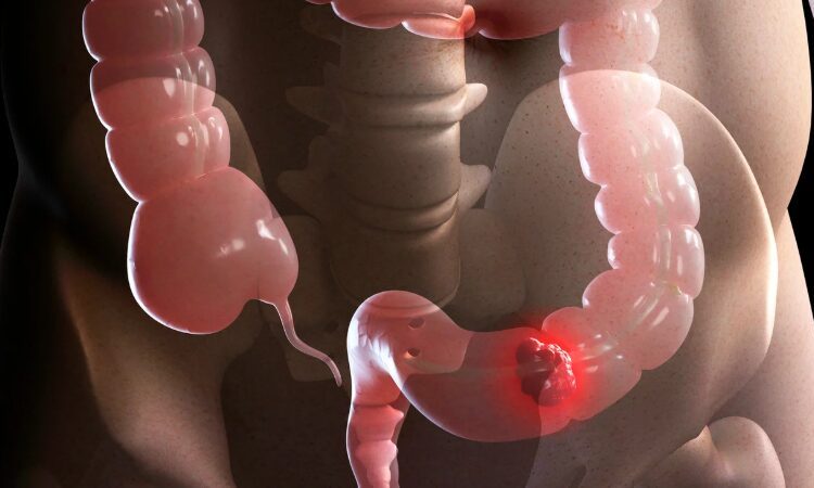 El cáncer colorrectal se protege de la inmunoterapia con un doble escudo, según un estudio