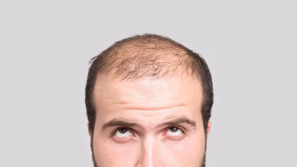 Caída del cabello: mitos, causas médicas y cuándo acudir al especialista para un tratamiento efectivo