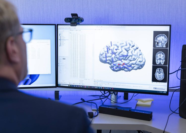 IA y dispositivos portátiles transforman el tratamiento de la epilepsia