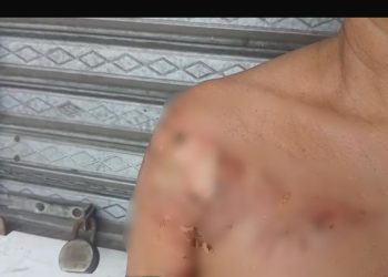 Mujer resulta con graves quemaduras tras ser atacada con aceite caliente por deuda de RD$1,000 en Moca