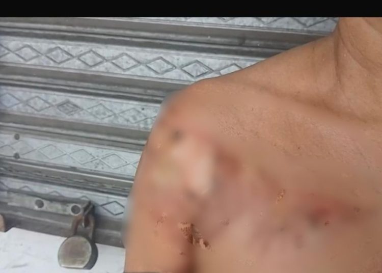 Mujer resulta con graves quemaduras tras ser atacada con aceite caliente por deuda de RD$1,000 en Moca