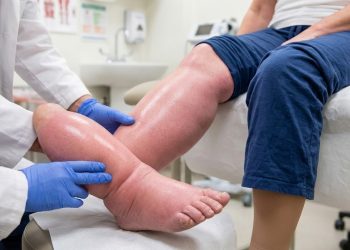 Día Internacional del Linfedema