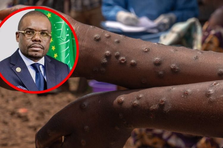 La República Democrática del Congo declara el fin de la viruela del mono