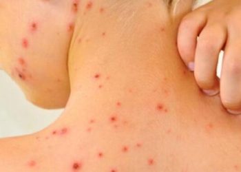 Perú confirma cuatro casos de sarampión en Lima, aunque descarta transmisión local