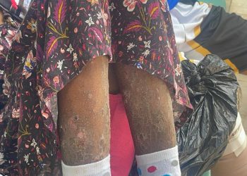 Denuncian abandono médico: niña enferma con extraña enfermedad espera por horas sin atención en hospital infantil de Santiago