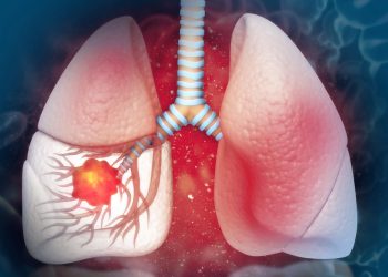 Humo que mata: 80% cáncer pulmón se asocia al tabaco