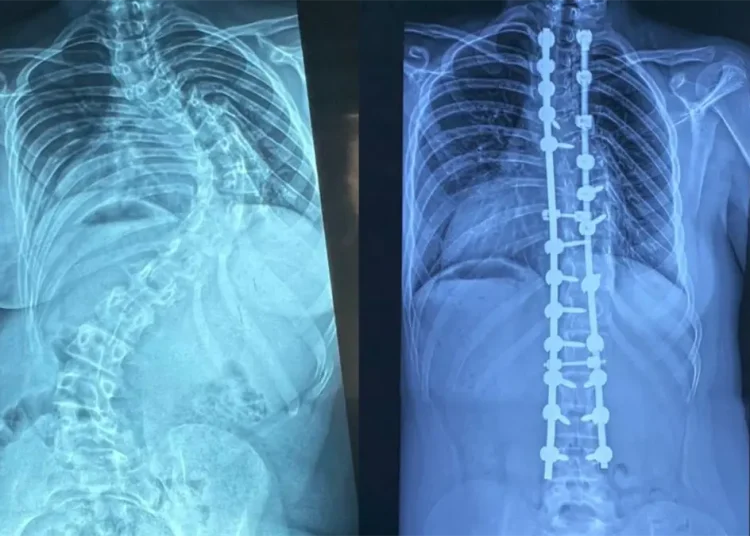 Especialistas realizan 347 cirugías de escoliosis pediátrica en los últimos cuatro años