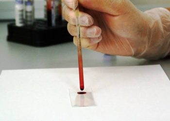 Estudio revela análisis de sangre que mejora la detección del cáncer de próstata agresivo