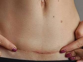 Cesáreas concentran más de dos tercios de los nacimientos en República Dominicana